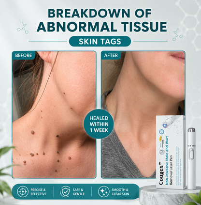Xorita Non-Invasive Mole & Wart Removal Pen